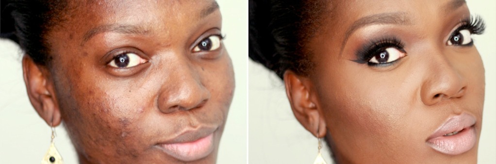 Two pictures of a woman before and after effect, showcasing the transformative effect of skin treatment after online dermatologist consultation.